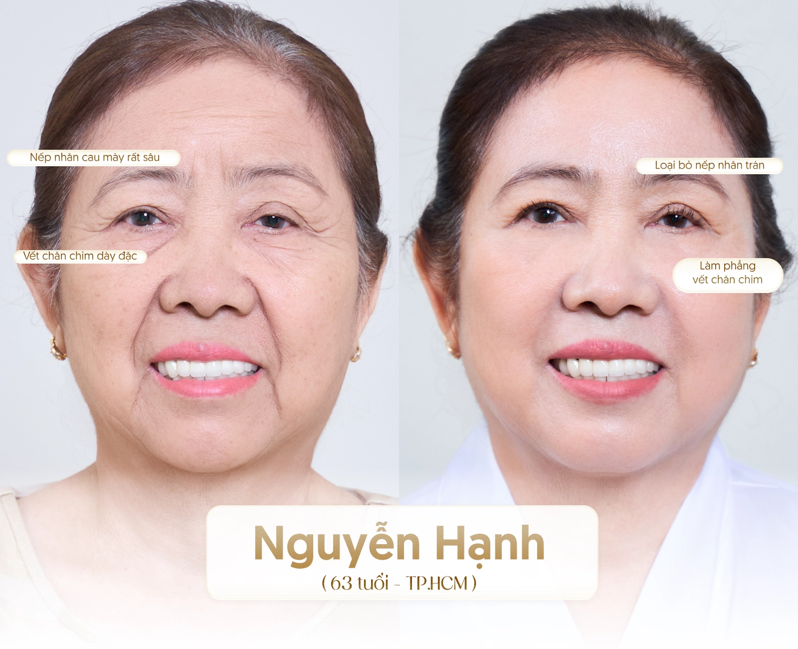 Hiệu quả công nghệ Youthlif4