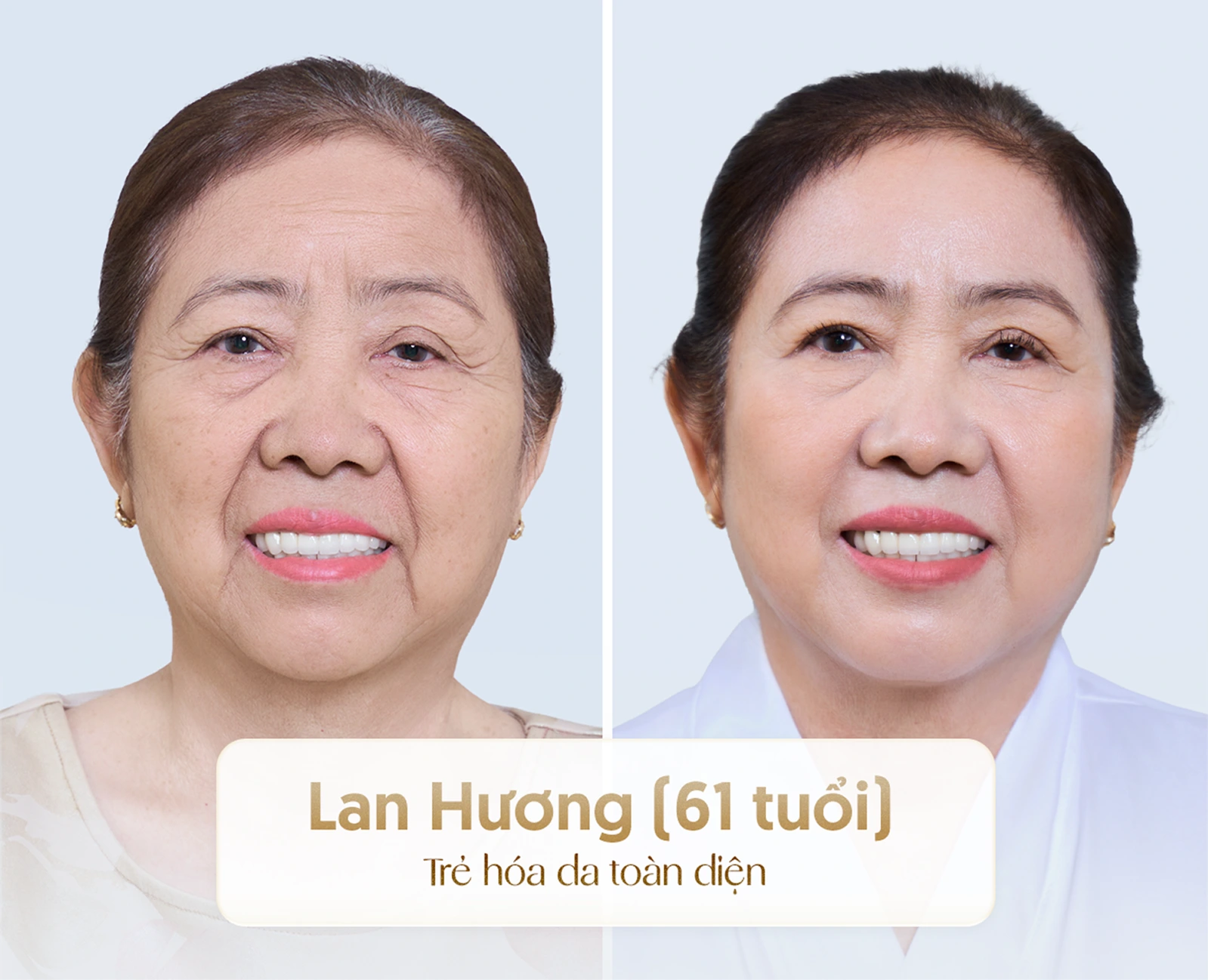 Hiệu quả nâng cơ trẻ hóa công nghệ cao 4