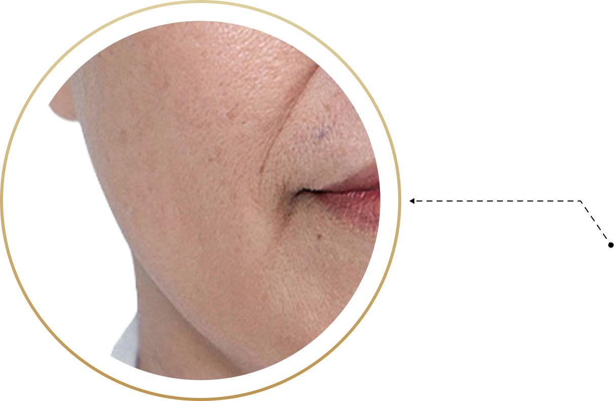 Má chảy xệ