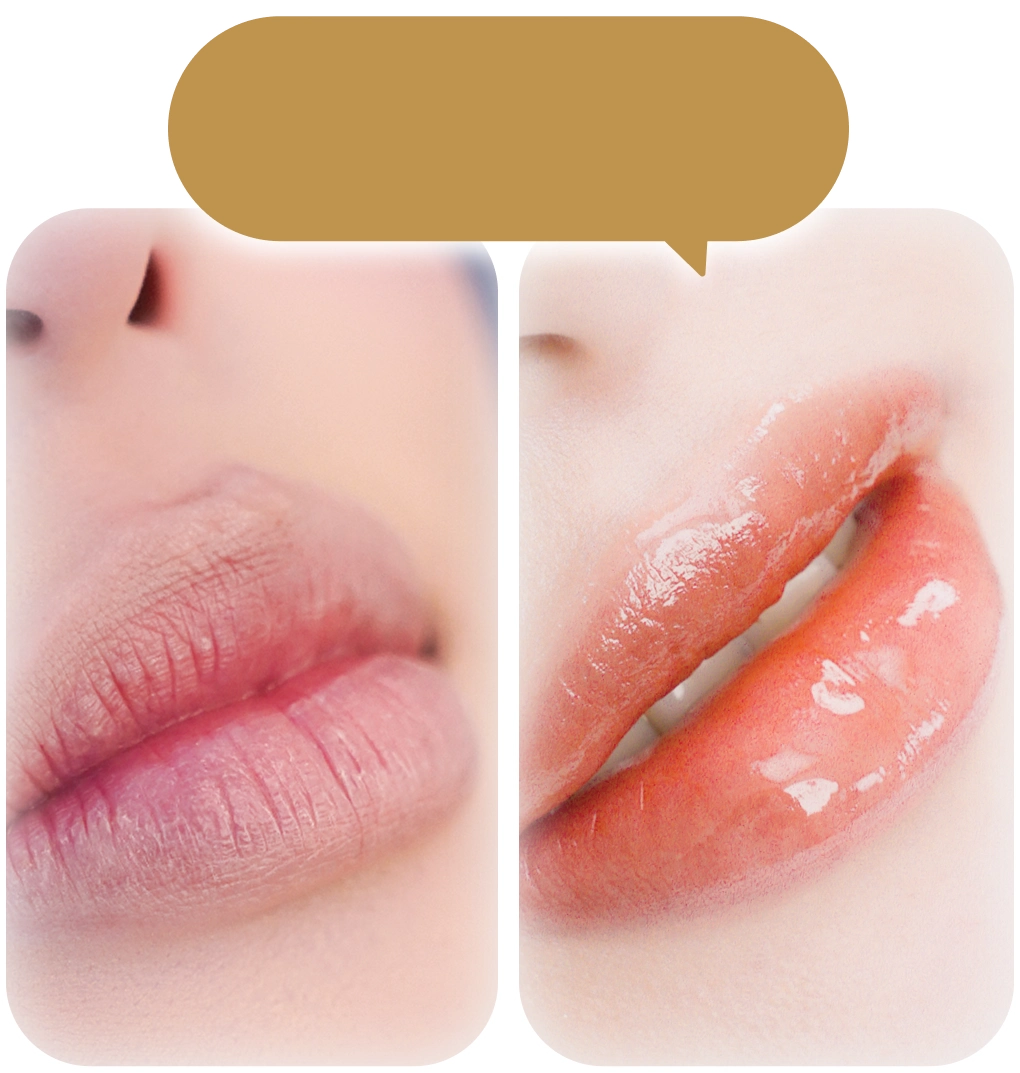 Phun môi collagen làm đầy rãnh môi và tái tạo môi căng bóng